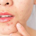 Top 6 Factors That Promote Adult Acne
